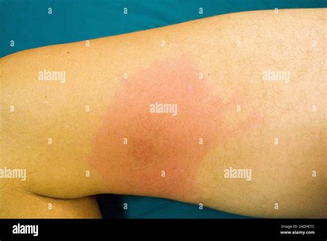 erythema migrans pronunciation|picture of tick bite rash.